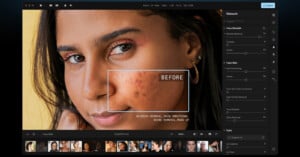 A close-up image of a person using a photo editing software with the retouch panel open. The screen shows a "Before" box highlighting the person's cheek with acne blemishes. Editing options such as blemish removal and skin smoothing are visible on the right.